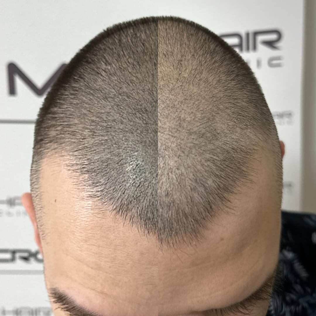 SMP tretman - fotografija iz galerije Micro Hair Clinic