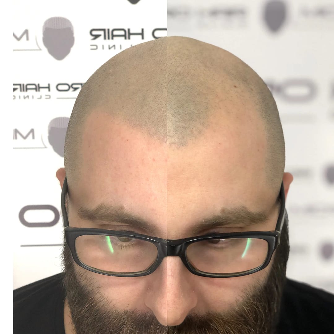 SMP tretman - fotografija iz galerije Micro Hair Clinic