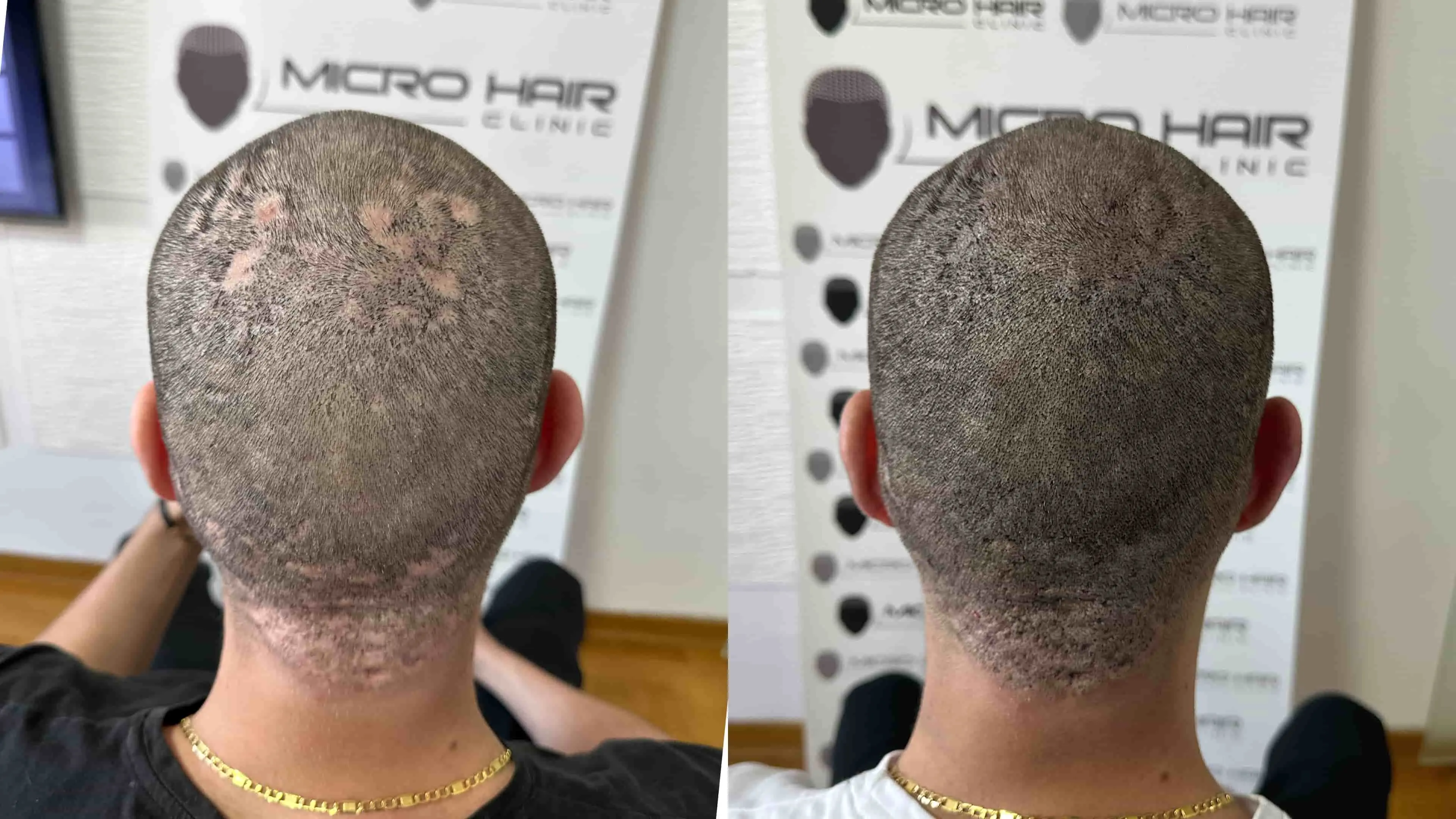 Alopecija – areata, totalis, universalis