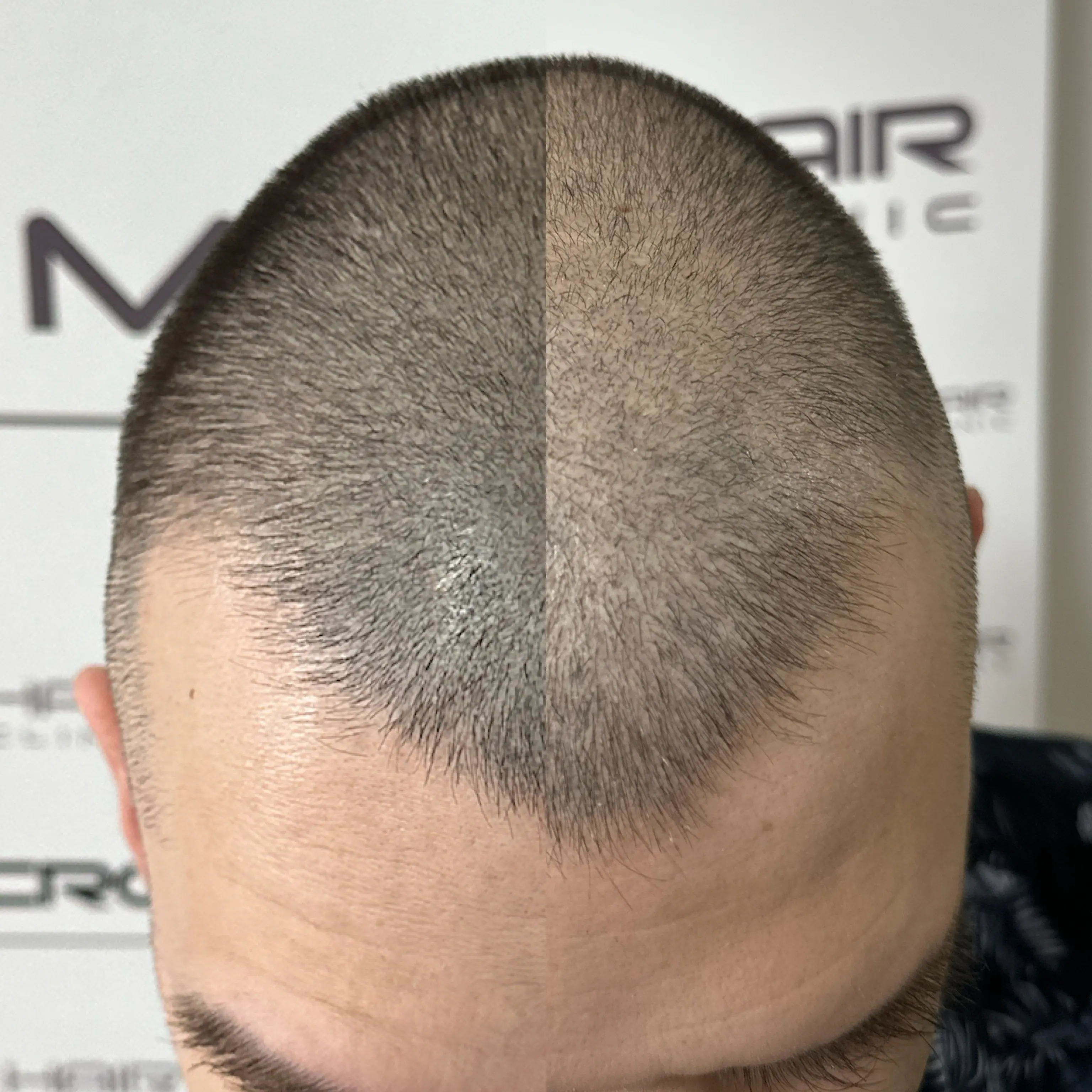 SMP tretman - fotografija iz galerije Micro Hair Clinic