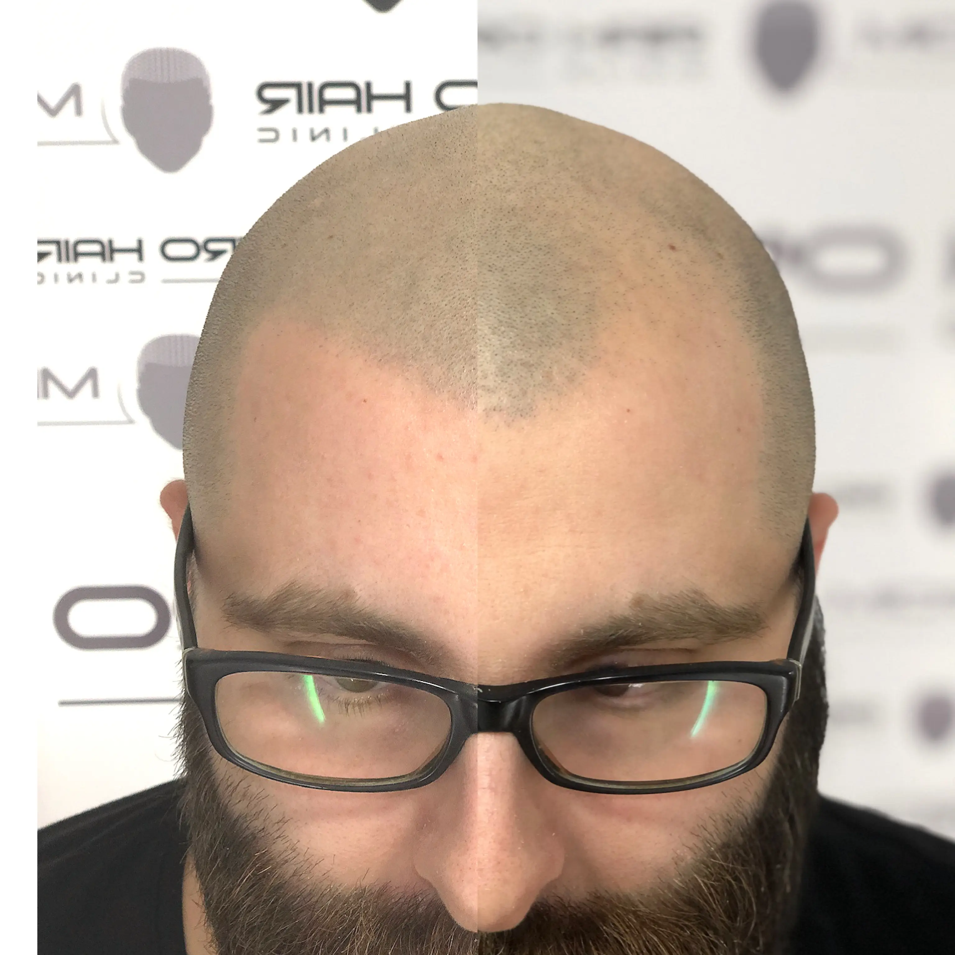 SMP tretman - fotografija iz galerije Micro Hair Clinic