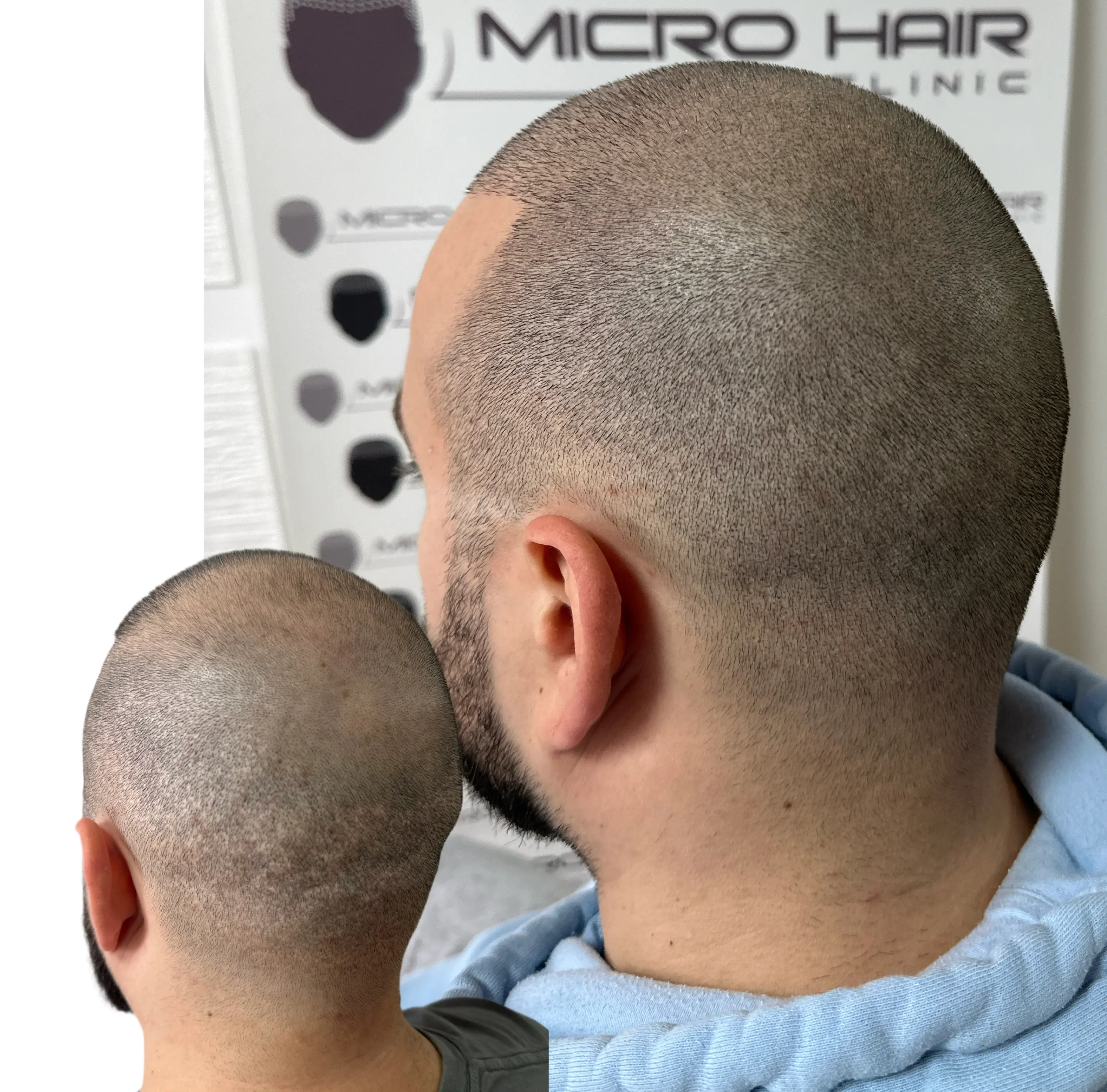 SMP tretman - fotografija iz galerije Micro Hair Clinic